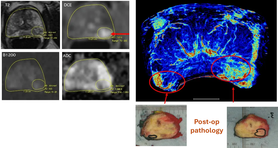 Image showing MRI images (left) and new super-resolution imaging (right) demonstrating missed tumour.